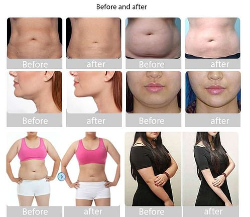 Cryolipolysis Fat Freezing Slimming - SNKOO BEAUTY