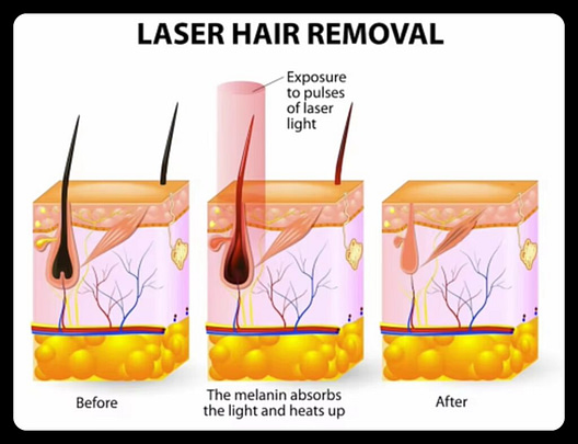 laser hair removal - SNKOO BEAUTY