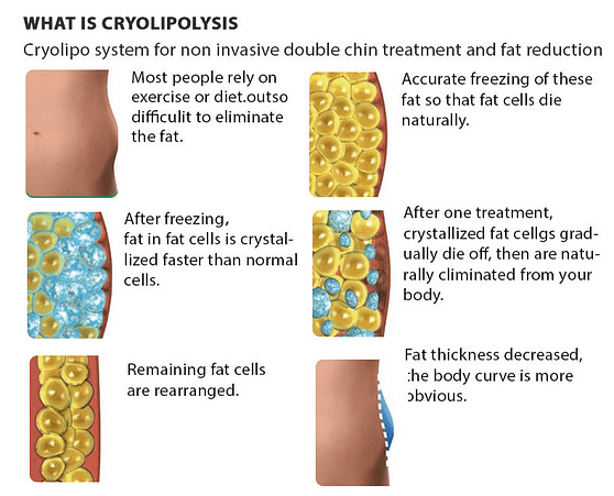 Cryolipolysis Fat Freezing Slimming - SNKOO BEAUTY