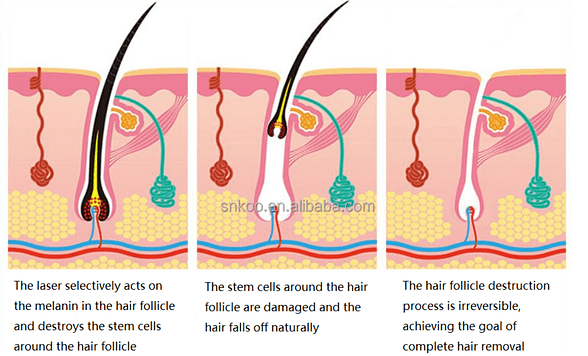 Diode Laser Hair Removal - SNKOO BEAUTY