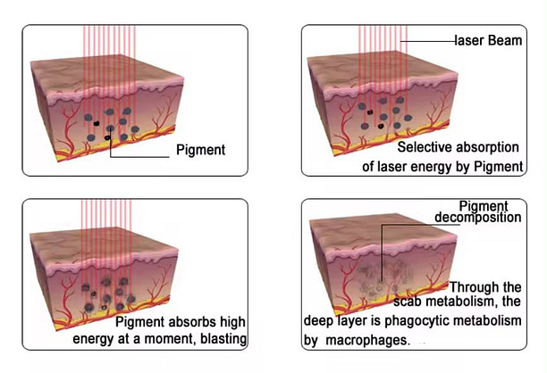 Picosecond Laser Technology - SNKOO BEAUTY