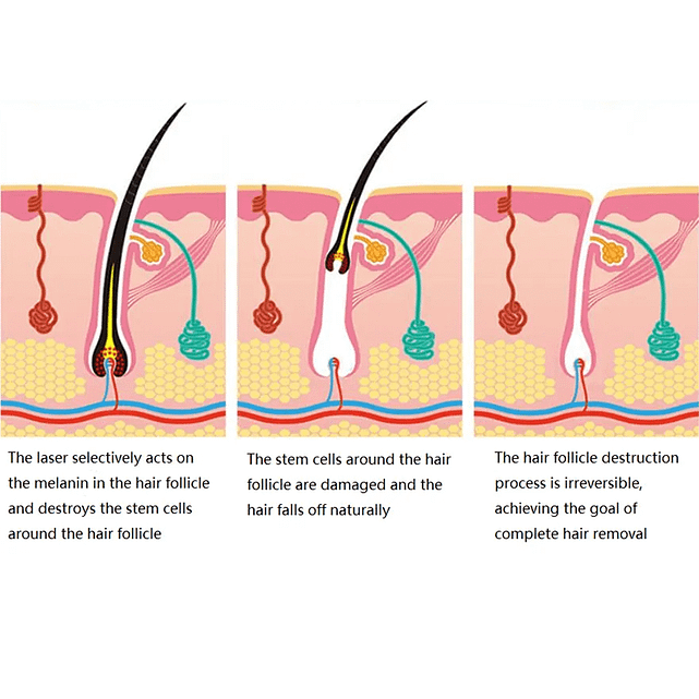 Diode Laser Hair Removal - SNKOO BEAUTY